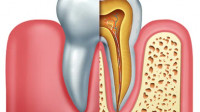 Root Canal Treatment
