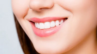 Veneers