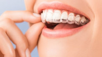 Invisalign