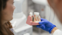 Dental Implants