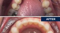 Invisalign Coventry