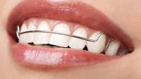 Removable Braces