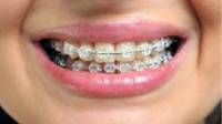 Ceramic Braces