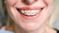 Fixed Braces