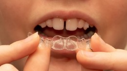 Invisalign Braces
