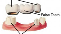 Dental Bridges