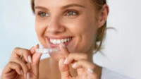 Invisalign