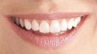 Dental Veneers