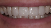 Composite Bonding