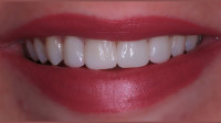 Dental Veneers